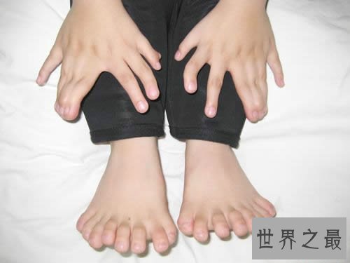 世界手指和脚趾最多的人，15个手指/16个脚趾