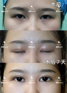 ​做双眼皮哪种好 双眼皮到底选择哪种手术好？