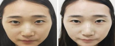 ​太阳晒斑怎么祛